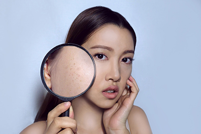 如何祛斑成功？美容科專家教你有效方法